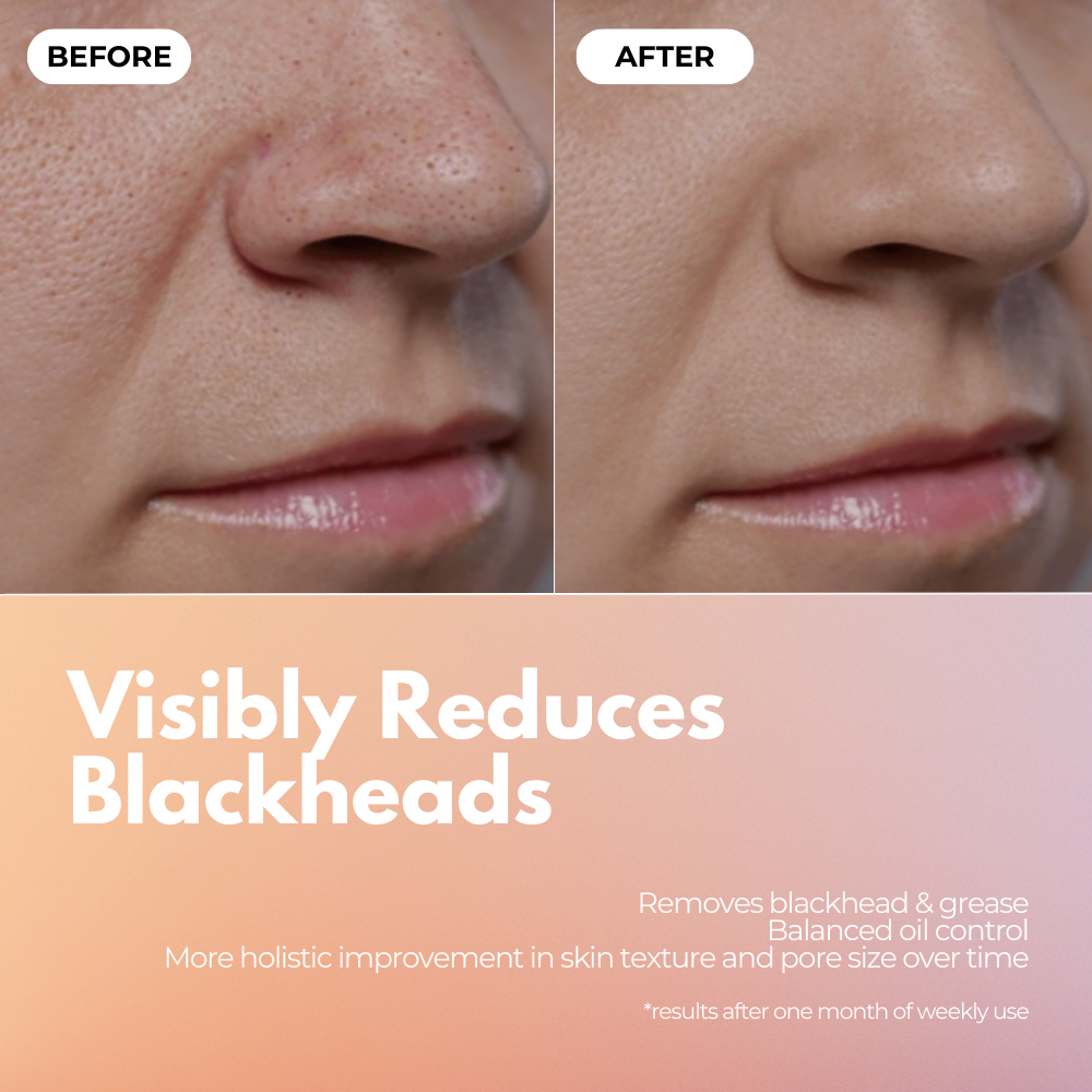 Blackhead Remover & Deep Pore Cleanser