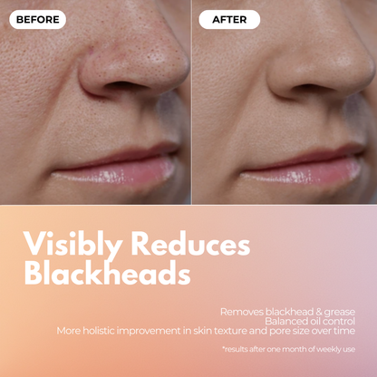 Blackhead Remover & Cleanser