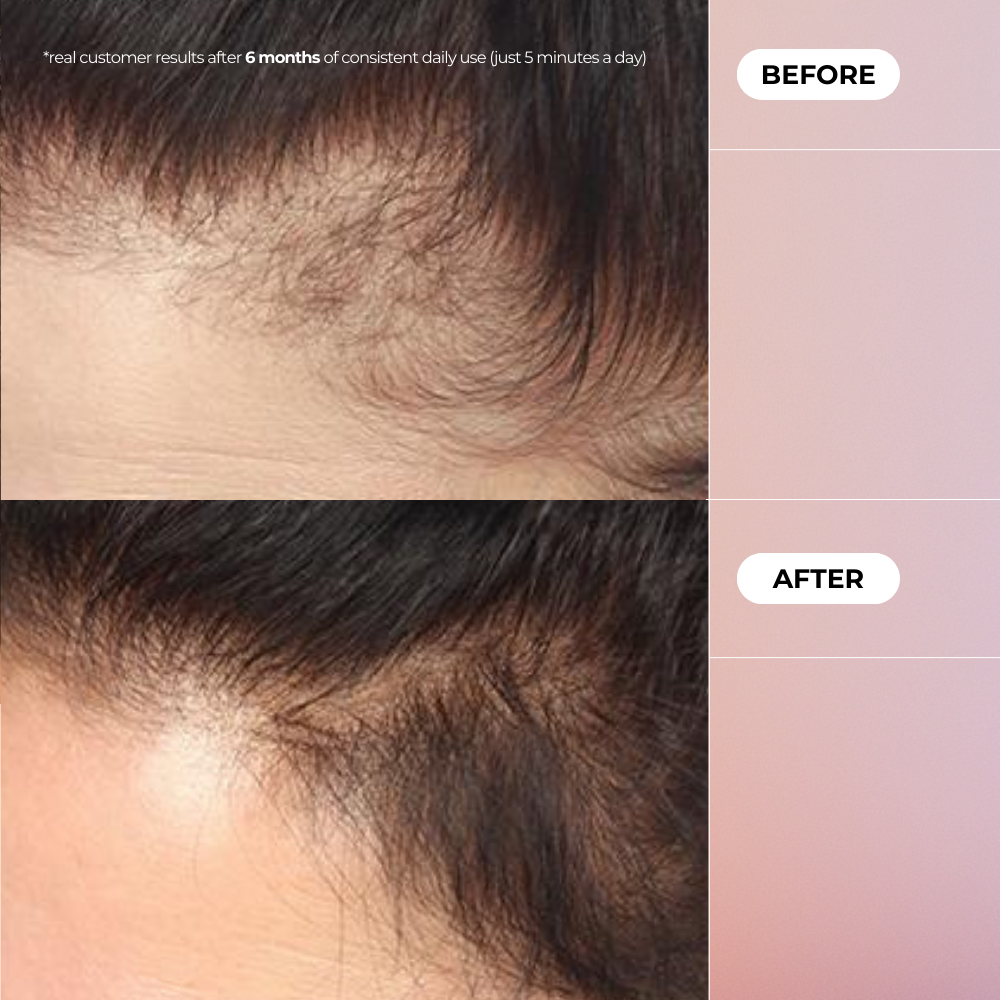 EMS Massager for Hair Growth